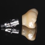 implant