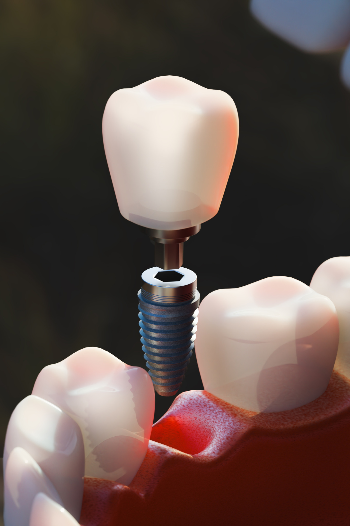 implants-treatments-04