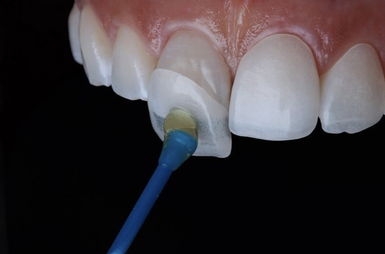 Smile Makeover: Do You Really Need Veneers? | SmileBay Specialist Centre