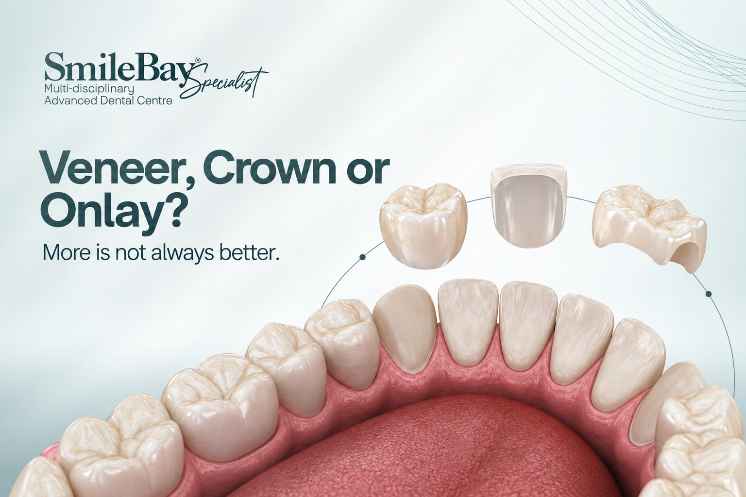 Veneer, Crown or Onlay? More Is Not Always Better